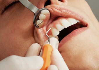 Stomatološka ordinacija, stomatolog Novi Beograd, izbeljivanje zuba